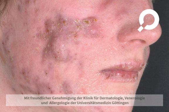 Akne (Acne vulgaris)  
