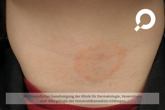 Tinea corporis