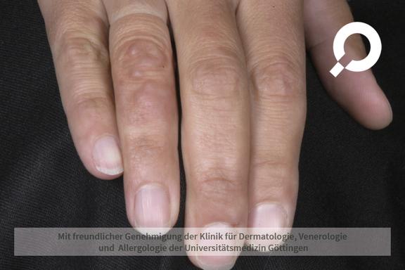 Granuloma anulare