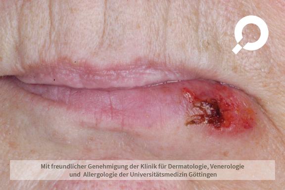 Herpes labialis (Lippenherpes)