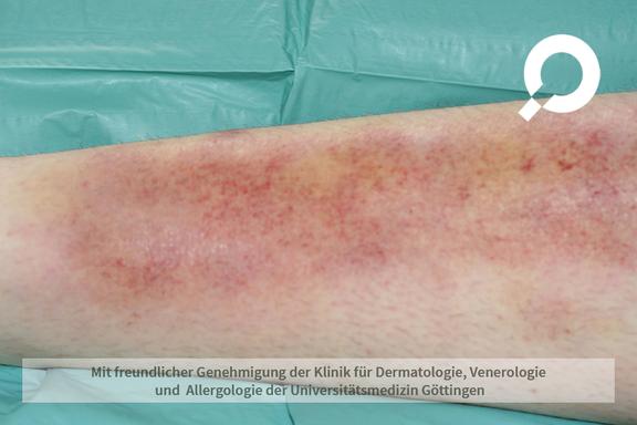 Erythema nodosum