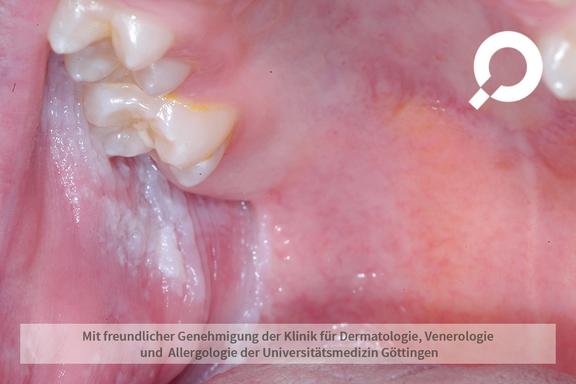Leukoplakie (Weißschwielenkrankheit)