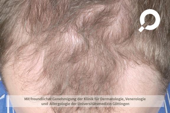 Androgenetische Alopezie (androgenetischer Haarausfall) 