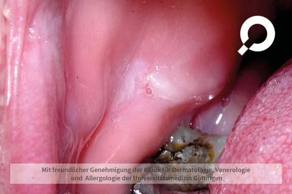 Leukoplakie (Weißschwielenkrankheit)
