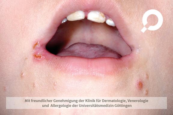 Molluscum contagiosum (Dellwarzen)