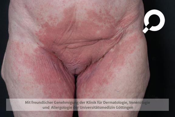 Psoriasis inversa