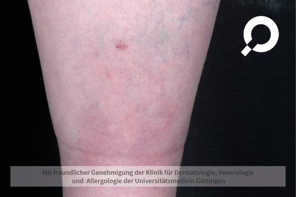 Erythema nodosum