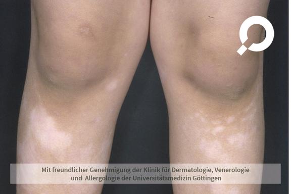 Vitiligo (Weißfleckenkrankheit) 