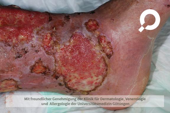 Ulcus cruris (offenes Bein)