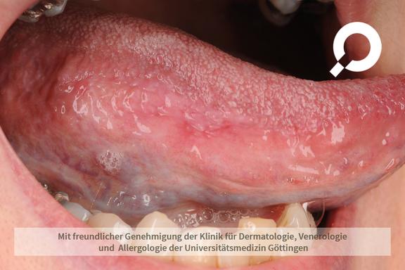 Leukoplakie (Weißschwielenkrankheit)