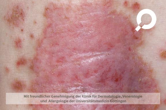 Pityriasis rosea (Röschenflechte)