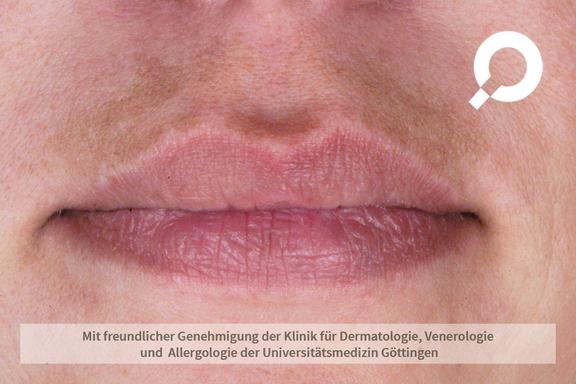 Melasma (Pigmentierungen)
