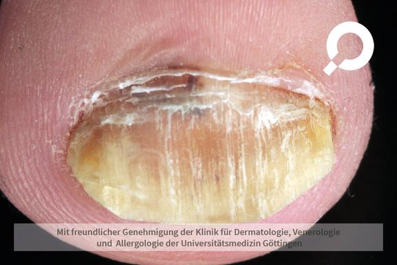 Nagelpsoriasis (Schuppenflechte der Nägel) 