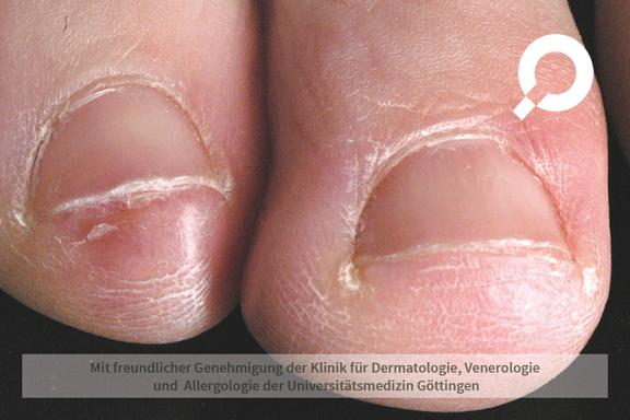 Raynaud-Syndrom