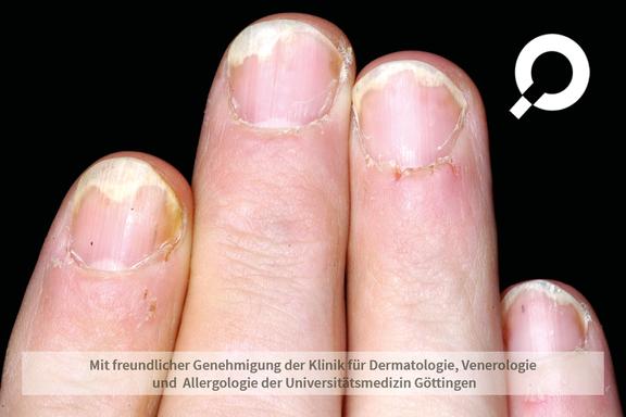Nagelpsoriasis (Schuppenflechte der Nägel) 