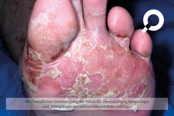 Allergisches Kontaktekzem (allergische Kontaktdermatitis)