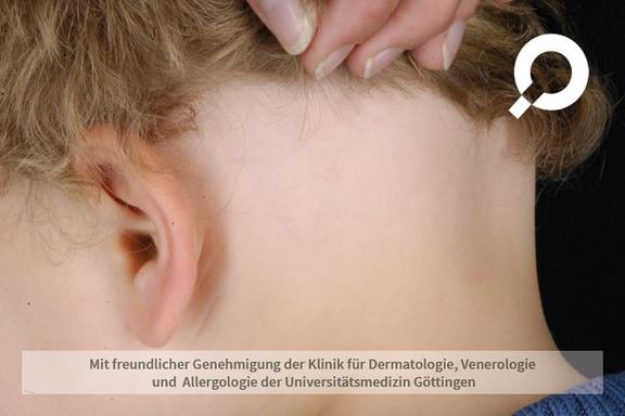 Alopecia areata (kreisrunder Haarausfall) 