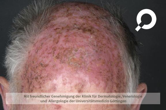 Aktinische Keratose