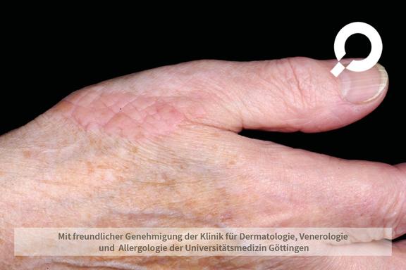 Lichen ruber planus (Knötchenflechte)