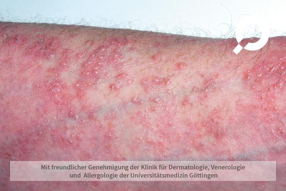 Psoriasis vulgaris (Schuppenflechte)