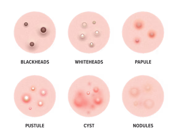 Blackheads, Whiteheads, Papeln, Pusteln, Zysten, Knoten