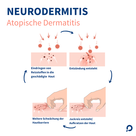 Illustration des Teufelskreis bei der Neurodermitis - das Jucken und Kratzen schädigt die Hautbarriere, wodurch Reizstoffe in die Haut eindringen und eine Entzündung entstehen kann
