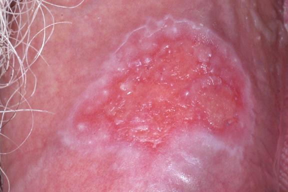 Herpes genitalis (Genitalherpes) 