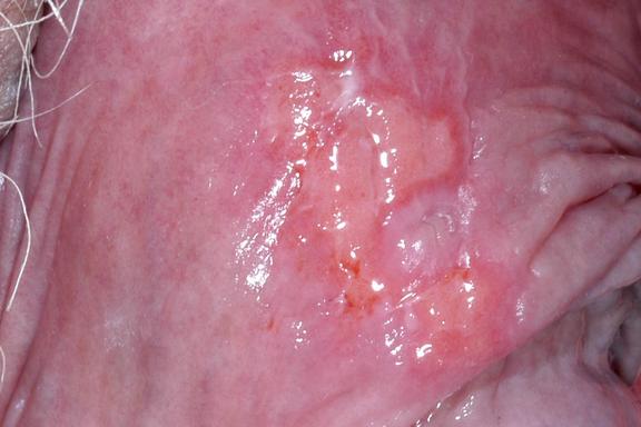 Herpes genitalis (Genitalherpes) 