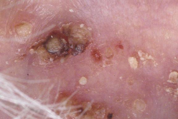 Follikulitis (Haarbalgentzündung)