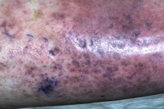 Stauungsdermatitis