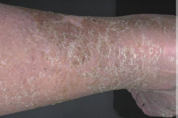 Stauungsdermatitis