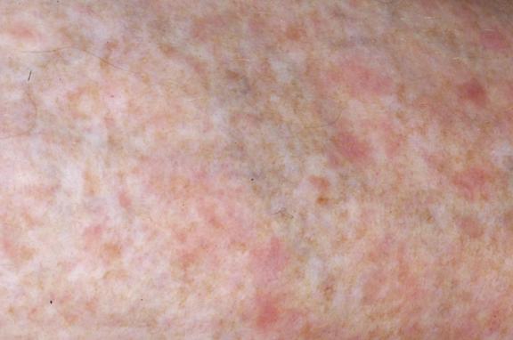 Polymorphe Lichtdermatose (Sonnenallergie)