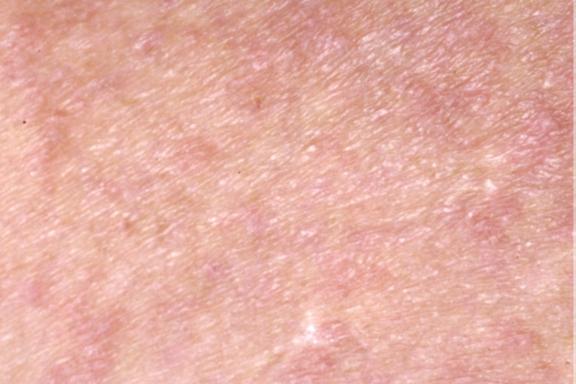 Dermatitis herpetiformis Duhring