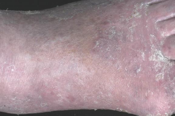 Stauungsdermatitis