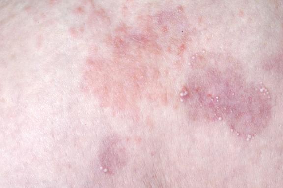 Dermatitis herpetiformis Duhring