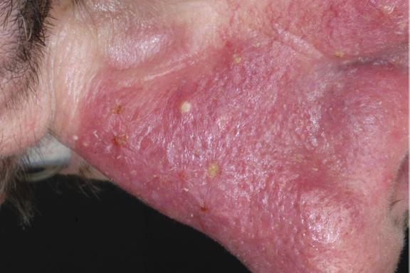 Rosacea (Rosazea)