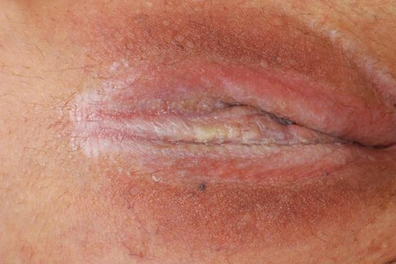 Lichen sclerosus et atrophicus 