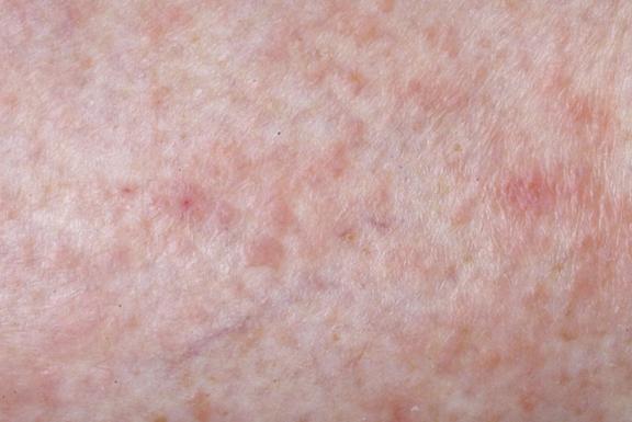Polymorphe Lichtdermatose (Sonnenallergie)