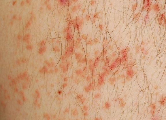 Morbus Darier (Dyskeratosis follikularis)