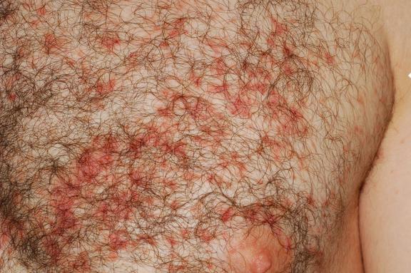 Morbus Darier (Dyskeratosis follikularis)