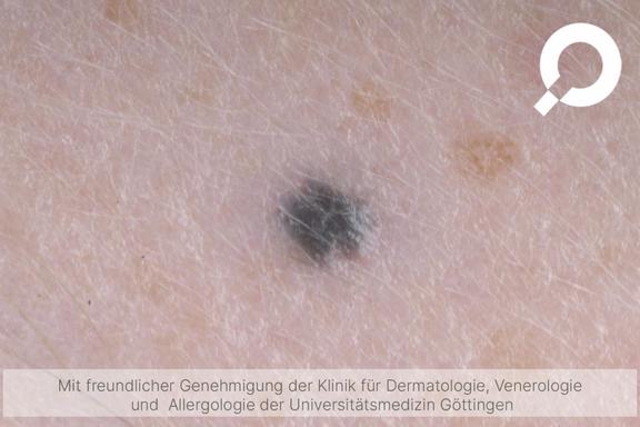 Blaues Muttermal / blauer Nävus (Nävus bleu)