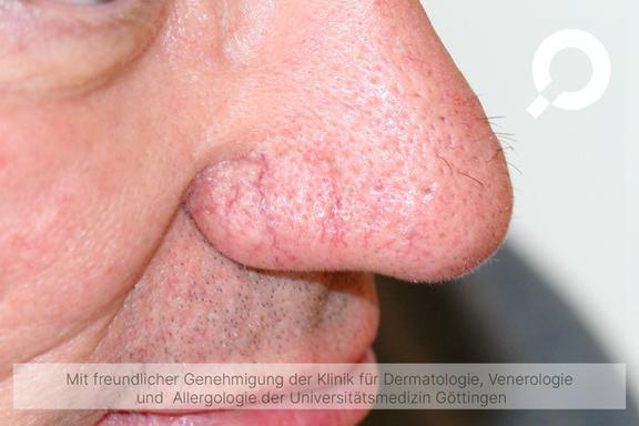 Rosacea (Rosazea)