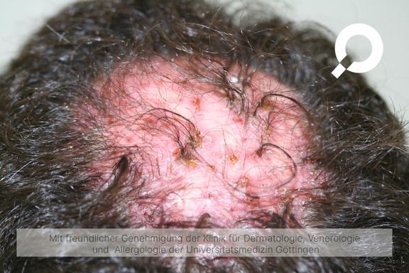 Follikulitis (Haarbalgentzündung)