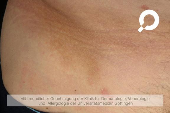 Pigmentflecken (Hyperpigmentierung)