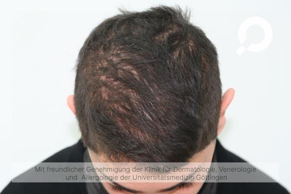 Diffuser Haarausfall (Effluvium)