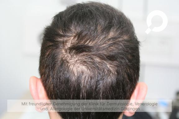 Diffuser Haarausfall (Effluvium)