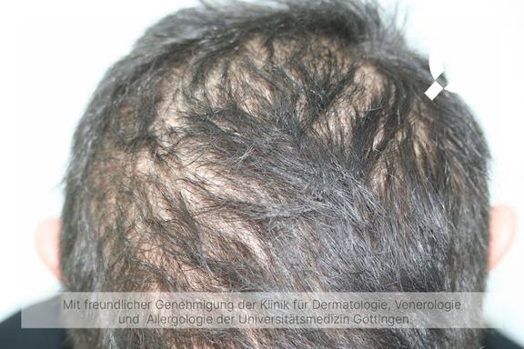 Diffuser Haarausfall (Effluvium)