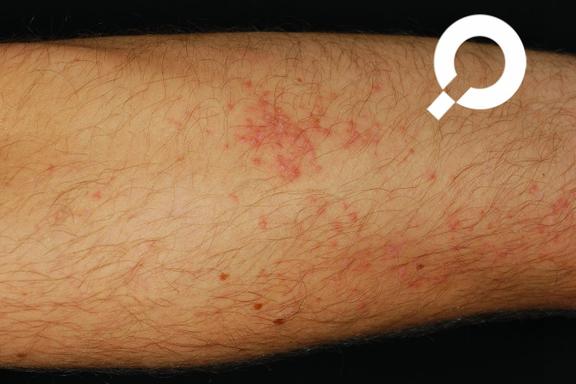 Morbus Darier (Dyskeratosis follikularis)