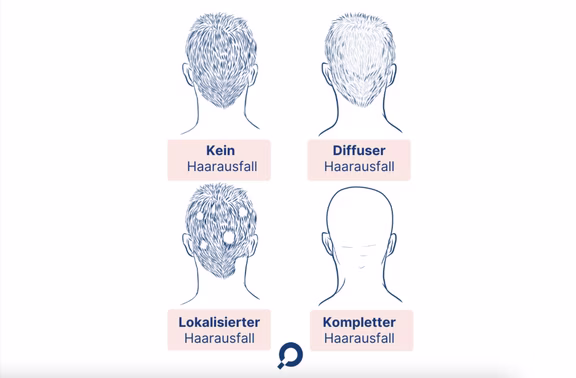 Arten von Haarausfall, diffuser Haarausfall, lokalisierter Haarausfall
