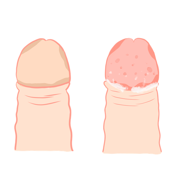 Illustration die eine gesunden mit einer an Balanitis erkrankten Eichel zeigt